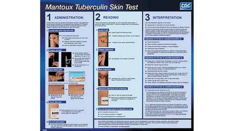 The TB (Tuberculosis) Skin Test (Mantoux) .